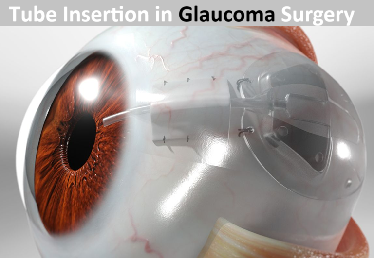 Tube Insertion in Glaucoma Surgery